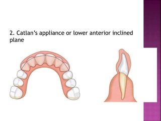 Cross bite and it's management venkat | PPTX