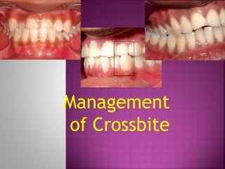 Management
of Crossbite
 