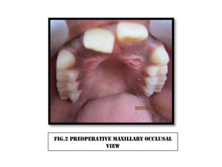 Cross bite correction