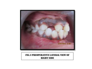 Cross bite correction