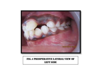 Cross bite correction
