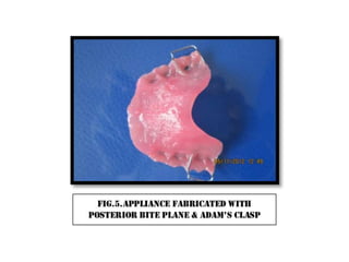 Cross bite correction