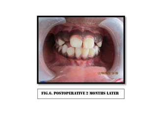Cross bite correction