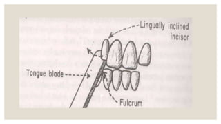 Crossbite is a form of malocclusion where a tooth (or teeth) has a more ...