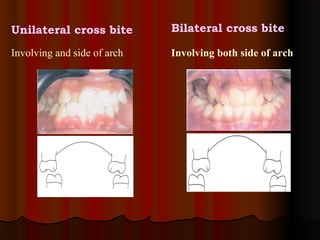 Unilateral cross bite        Bilateral cross bite

Involving and side of arch   Involving both side of arch
 