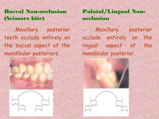 Buccal Non-occlusion        Palatal/Lingual Non-
(Scissors bite)             occlusion
-   Maxillary   posterior   -     Maxillary   posterior
teeth occlude entirely on   occlude entirely on the
the buccal aspect of the    lingual  aspect    of  the
mandibular posteriors.      mandibular posterior.
 
