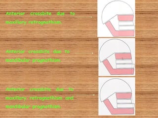 Anterior   crossbite   due   to
maxillary retrognathism.




Anterior crossbite due to
mandibular prognathism.




Anterior   crossbite due to
maxillary retrognathism and
mandibular prognathism.
 