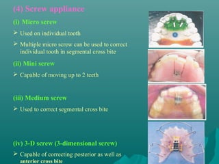 (4) Screw appliance
(i) Micro screw
 Used on individual tooth
 Multiple micro screw can be used to correct
  individual tooth in segmental cross bite
(ii) Mini screw
 Capable of moving up to 2 teeth


(iii) Medium screw
 Used to correct segmental cross bite




(iv) 3-D screw (3-dimensional screw)
 Capable of correcting posterior as well as
  anterior cross bite
 