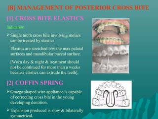 [B] MANAGEMENT OF POSTERIOR CROSS BITE
[1] CROSS BITE ELASTICS
Indication
 Single tooth cross bite involving molars
  can be treated by elastics
  Elastics are stretched b/w the max palatal
  surfaces and mandibular buccal surface.
  [Worn day & night & treatment should
  not be continued for more than a weeks
  because elastics can extrude the teeth].

[2] COFFIN SPRING
 Omega shaped wire appliance is capable
  of correcting cross bite in the young
  developing dentition.
 Expansion produced is slow & bilaterally
  symmetrical.
 
