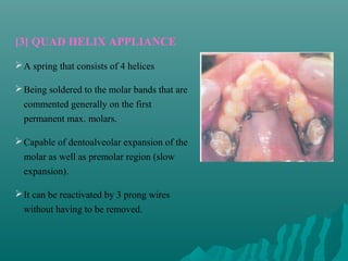 [3] QUAD HELIX APPLIANCE
 A spring that consists of 4 helices

 Being soldered to the molar bands that are
  commented generally on the first
  permanent max. molars.

 Capable of dentoalveolar expansion of the
  molar as well as premolar region (slow
  expansion).

 It can be reactivated by 3 prong wires
  without having to be removed.
 