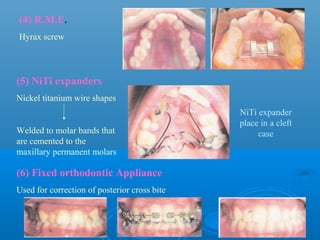 (4) R.M.E.
Hyrax screw




(5) NiTi expanders
Nickel titanium wire shapes
                                              NiTi expander
                                              place in a cleft
Welded to molar bands that                         case
are cemented to the
maxillary permanent molars

(6) Fixed orthodontic Appliance
Used for correction of posterior cross bite
 