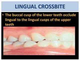 LINGUAL CROSSBITE
• The buccal cusp of the lower teeth occlude
lingual to the lingual cusps of the upper
teeth

 