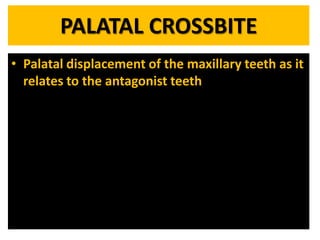 PALATAL CROSSBITE
• Palatal displacement of the maxillary teeth as it
relates to the antagonist teeth

 