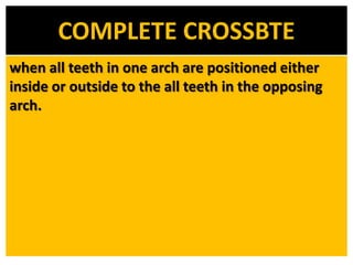 COMPLETE CROSSBTE
when all teeth in one arch are positioned either
inside or outside to the all teeth in the opposing
arch.

 