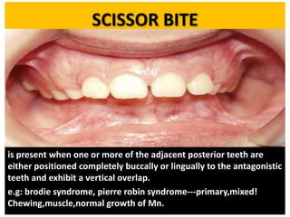 SCISSOR BITE

is present when one or more of the adjacent posterior teeth are
either positioned completely buccally or lingually to the antagonistic
teeth and exhibit a vertical overlap.
e.g: brodie syndrome, pierre robin syndrome---primary,mixed!
Chewing,muscle,normal growth of Mn.

 
