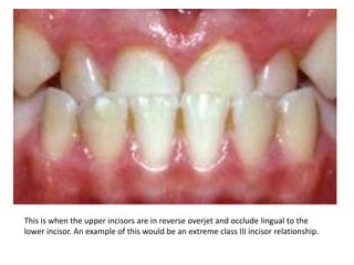 This is when the upper incisors are in reverse overjet and occlude lingual to the
lower incisor. An example of this would be an extreme class III incisor relationship.

 