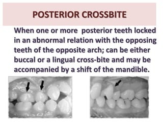 POSTERIOR CROSSBITE
When one or more posterior teeth locked
in an abnormal relation with the opposing
teeth of the opposite arch; can be either
buccal or a lingual cross-bite and may be
accompanied by a shift of the mandible.

 