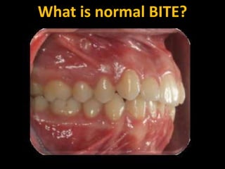 What is normal BITE?

 