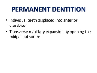 PERMANENT DENTITION
• Individual teeth displaced into anterior
crossbite
• Transverse maxillary expansion by opening the
midpalatal suture

 
