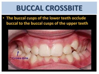 BUCCAL CROSSBITE
• The buccal cusps of the lower teeth occlude
buccal to the buccal cusps of the upper teeth

 