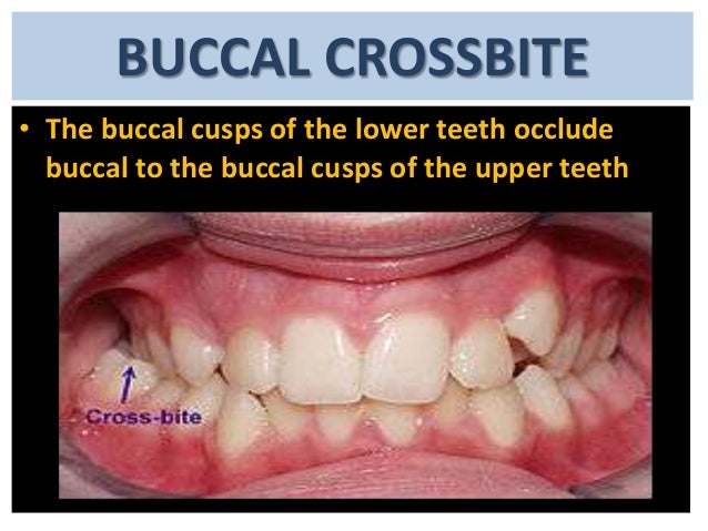 cross bite ppt crossbite