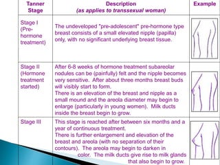 Tanner
Stage
Description
(as applies to transsexual woman)
Example
Stage I
(Pre-
hormone
treatment)
The undeveloped "pre-adolescent" pre-hormone type
breast consists of a small elevated nipple (papilla)
only, with no significant underlying breast tissue.
Stage II
(Hormone
treatment
started)
After 6-8 weeks of hormone treatment subareolar
nodules can be (painfully) felt and the nipple becomes
very sensitive. After about three months breast buds
will visibly start to form.
There is an elevation of the breast and nipple as a
small mound and the areola diameter may begin to
enlarge (particularly in young women). Milk ducts
inside the breast begin to grow.
Stage III This stage is reached after between six months and a
year of continuous treatment.
There is further enlargement and elevation of the
breast and areola (with no separation of their
contours). The areola may begin to darken in
color. The milk ducts give rise to milk glands
that also begin to grow.
 