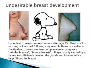 Hypoplastic breasts, more common after age 25. Very small or
narrow, lack normal fullness, may seem bulbous or swollen at
the tip due to over-prominent nipple-areolar complex -
"tubular breasts", “Snoopy breasts". Shape usually caused by a
failure to sufficiently develop the glands and lobules which
help fill out the breast.
 