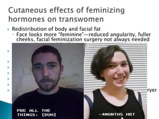  Redistribution of body and facial fat
◦ Face looks more “feminine”—reduced angularity, fuller
cheeks, facial feminization surgery not always needed
◦ Redistribution of fat from waist to hips and buttocks
 Skin softer/smoother/thinner, more translucent, less
greasy
 Skin sometimes becomes excessively dry
 Improvement in spots and acne
 Redistribution of fat to hips and buttocks
 Brittle fingernails (lack of sebaceous oil)
 Increased susceptibility to scratching and bruising
 Oil and sweat glands become less active, resulting in dryer
skin, scalp, and hair
 