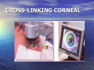CROSS-LINKING CORNEAL 