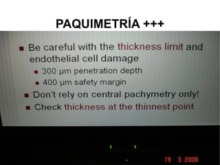 PAQUIMETRÍA +++ 