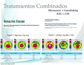 Tratamientos Combinados
                                                                              Microwave + Crosslinking
                                                                                    KXL + CXL




             Patient 1 Right Eye, CXL only                                    Patient 1 Left Eye, Keraflex + CXL




     !"#$%&#"'()#*+,        -,.%/01,&%20$%&,   3,.%/012,&%20$%&,      !"#$%&#"'()#*+,        -."#/0*+,&%10$2#"'3#4,   5,-'+1,&%10$678,
      !"#$%&'&()*+&              (,*-&               ()*.&             !"#$%&'&()*+&                 ,-*.&                 /,*/&
     /012$31&!&'&4(*5&           4(*5&               4+*,&            0123$42&!&'&,(*.&              .5*.&                 .(*6&
  677&89&:;<12:=2&'&(4*.&        ((*4&               (5*4&         677&89&:;<23:=3&'&/+*6&           .5*6&                 .)*5&



lunes 9 de mayo de 2011
 