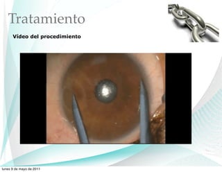 Tratamiento
      Vídeo del procedimiento




lunes 9 de mayo de 2011
 