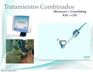 Tratamientos Combinados
                          Microwave + Crosslinking
                                KXL + CXL




lunes 9 de mayo de 2011
 