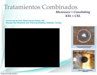 Tratamientos Combinados
                          Microwave + Crosslinking
                                KXL + CXL




lunes 9 de mayo de 2011
 