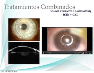 Tratamientos CombinadosCrosslinking
                   Anillos Corneales +
                           ICRs + CXL




lunes 9 de mayo de 2011
 