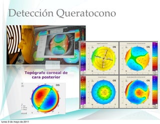 Detección Queratocono




                   Topógrafo corneal de
                      cara posterior




lunes 9 de mayo de 2011
 