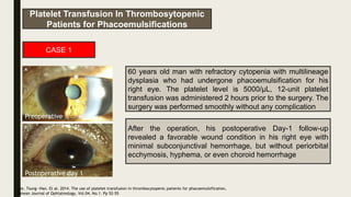 Platelet Transfusion In Thrombosytopenic
Patients for Phacoemulsifications
Lee, Tsung—Han. Et al. 2014. The use of platelet transfusion in thrombocytopenic patients for phacoemulsification.
Taiwan Journal of Ophtalmology. Vol.04. No.1. Pp 52-55
60 years old man with refractory cytopenia with multilineage
dysplasia who had undergone phacoemulsification for his
right eye. The platelet level is 5000/µL, 12-unit platelet
transfusion was administered 2 hours prior to the surgery. The
surgery was performed smoothly without any complication
After the operation, his postoperative Day-1 follow-up
revealed a favorable wound condition in his right eye with
minimal subconjunctival hemorrhage, but without periorbital
ecchymosis, hyphema, or even choroid hemorrhage
Preoperative
Postoperative day 1
CASE 1
 