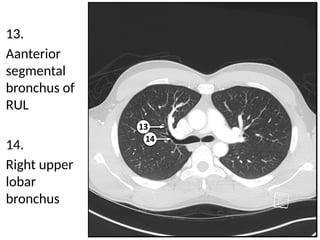 Detailed Cross Sectional Anatomy of the Chest Using Lung Window Imaging ...