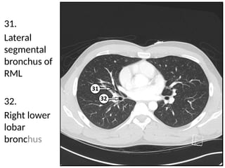 Detailed Cross Sectional Anatomy of the Chest Using Lung Window Imaging ...