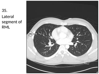 Detailed Cross Sectional Anatomy of the Chest Using Lung Window Imaging ...