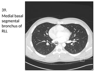 Detailed Cross Sectional Anatomy of the Chest Using Lung Window Imaging ...