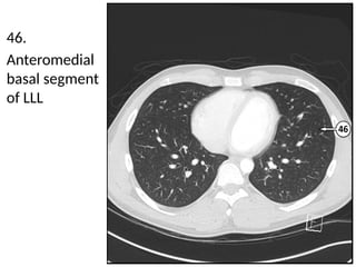 Llsb Detailed Cross Sectional Anatomy of the Chest Using Lung Window Imaging ...