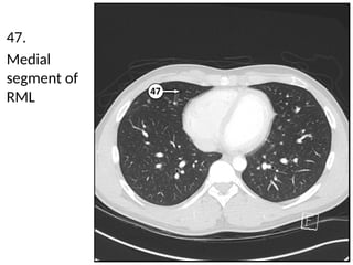 Detailed Cross Sectional Anatomy of the Chest Using Lung Window Imaging ...