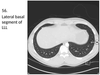 Llsb Detailed Cross Sectional Anatomy of the Chest Using Lung Window Imaging ...