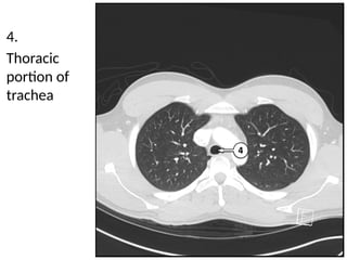 Trachea Radiology Detailed Cross Sectional Anatomy of the Chest Using Lung Window Imaging ...
