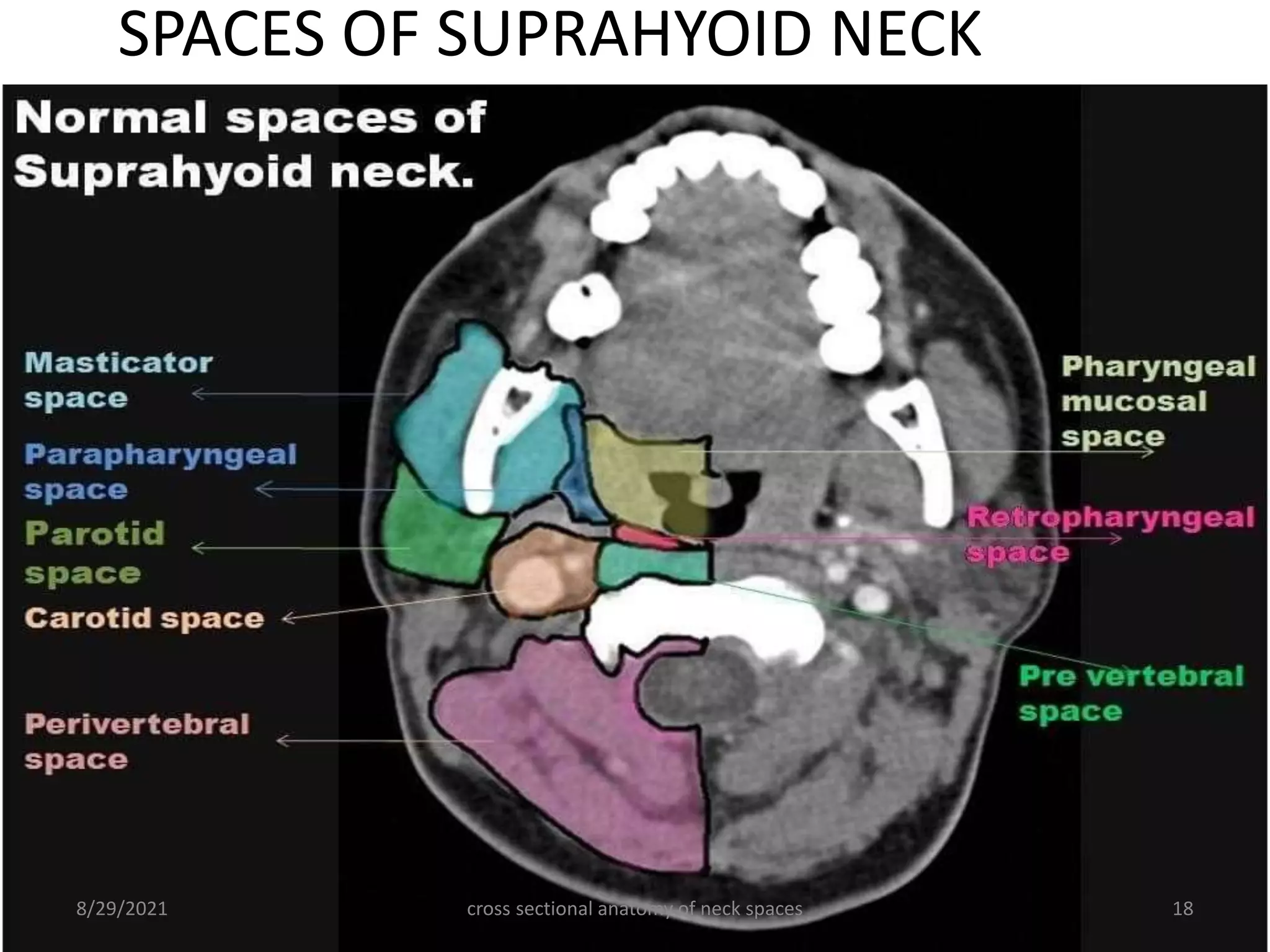 SPACES OF SUPRAHYOID NECK
cross sectional anatomy of neck spaces 18
8/29/2021
 