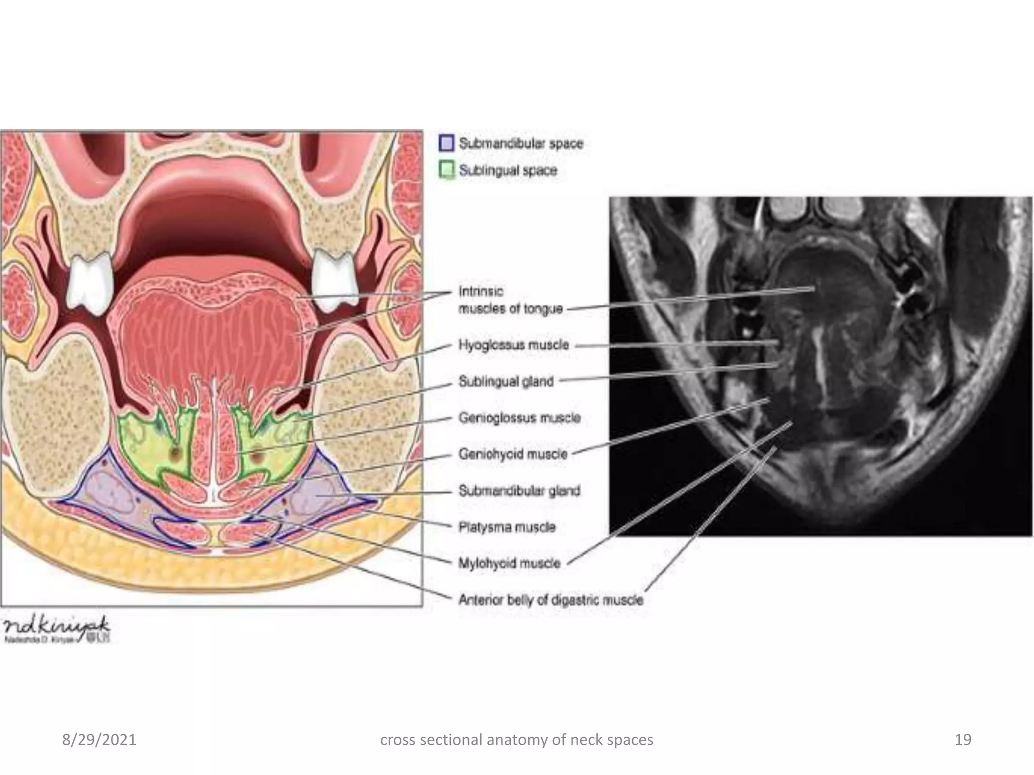 8/29/2021 cross sectional anatomy of neck spaces 19
 