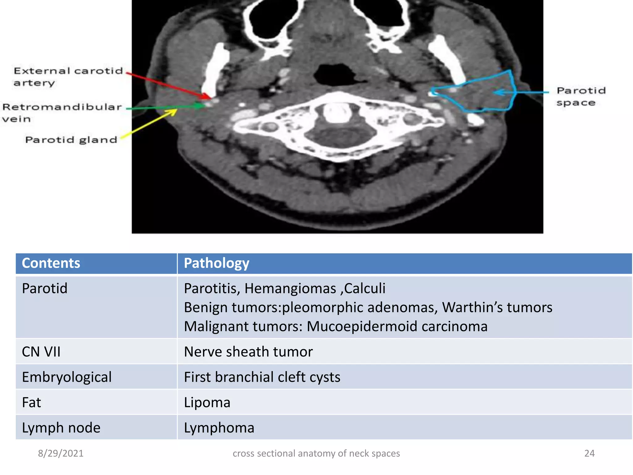 Contents Pathology
Parotid Parotitis, Hemangiomas ,Calculi
Benign tumors:pleomorphic adenomas, Warthin’s tumors
Malignant tumors: Mucoepidermoid carcinoma
CN VII Nerve sheath tumor
Embryological First branchial cleft cysts
Fat Lipoma
Lymph node Lymphoma
8/29/2021 cross sectional anatomy of neck spaces 24
 