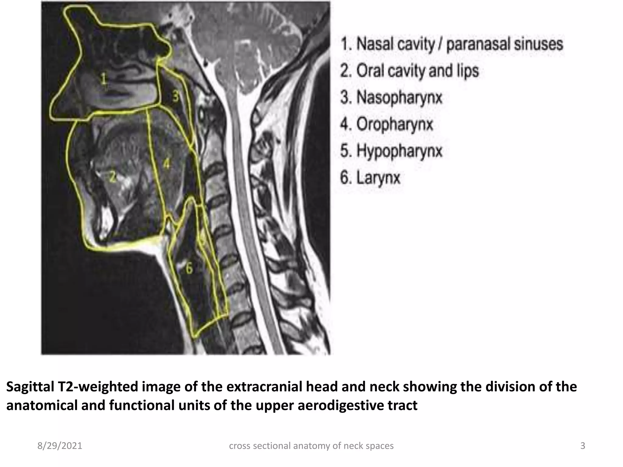 Sagittal T2-weighted image of the extracranial head and neck showing the division of the
anatomical and functional units of the upper aerodigestive tract
cross sectional anatomy of neck spaces 3
8/29/2021
 