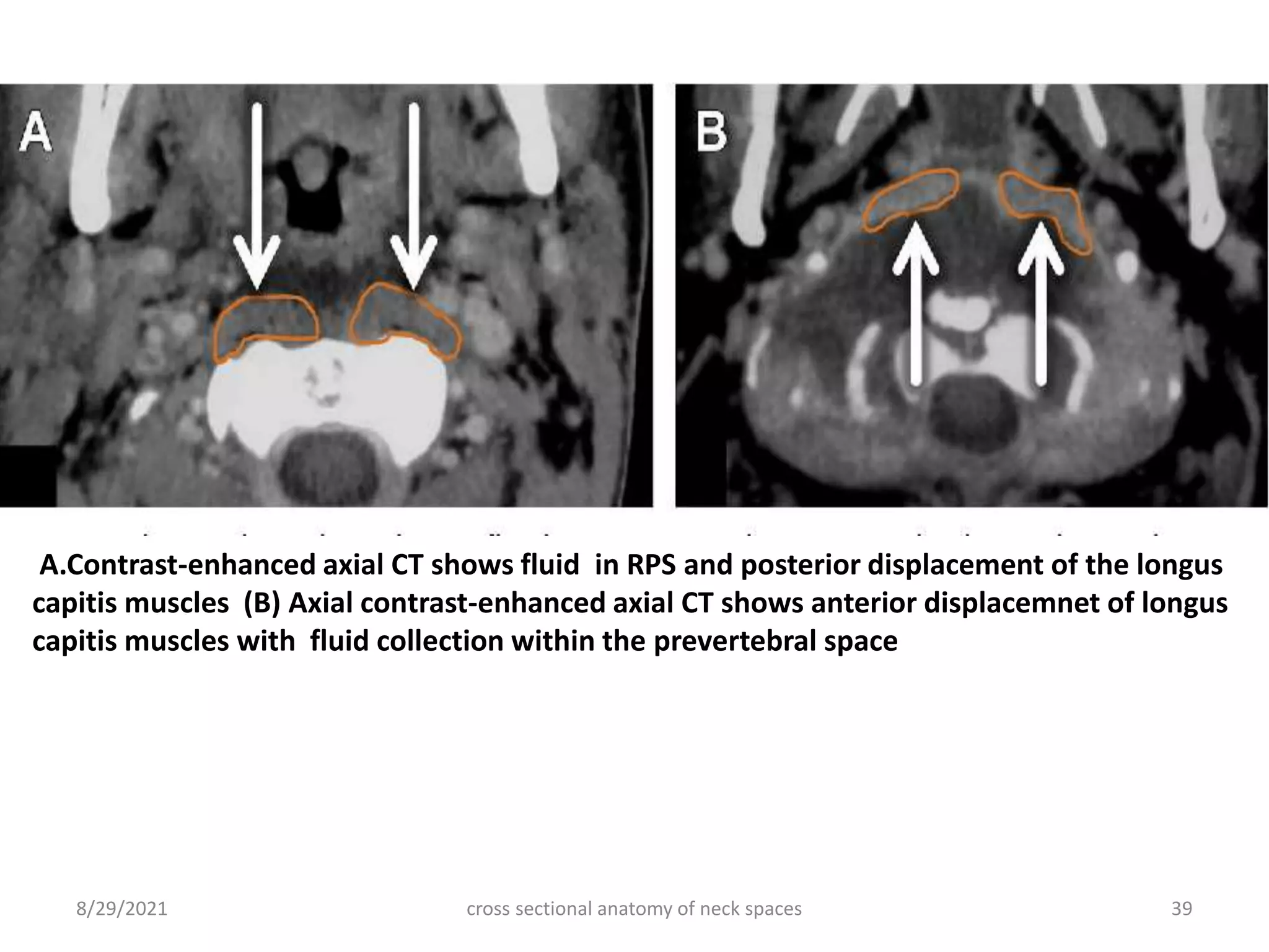 cross sectional anatomy of neck spaces 39
8/29/2021
A.Contrast-enhanced axial CT shows fluid in RPS and posterior displacement of the longus
capitis muscles (B) Axial contrast-enhanced axial CT shows anterior displacemnet of longus
capitis muscles with fluid collection within the prevertebral space
 